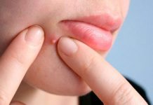 Lưu Huỳnh Trị Mụn Có Thật Sự Hiệu Quả Hay Không? Đi Tìm Sự Thật Lưu Huỳnh Trị Mụn