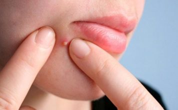 Lưu Huỳnh Trị Mụn Có Thật Sự Hiệu Quả Hay Không? Đi Tìm Sự Thật Lưu Huỳnh Trị Mụn