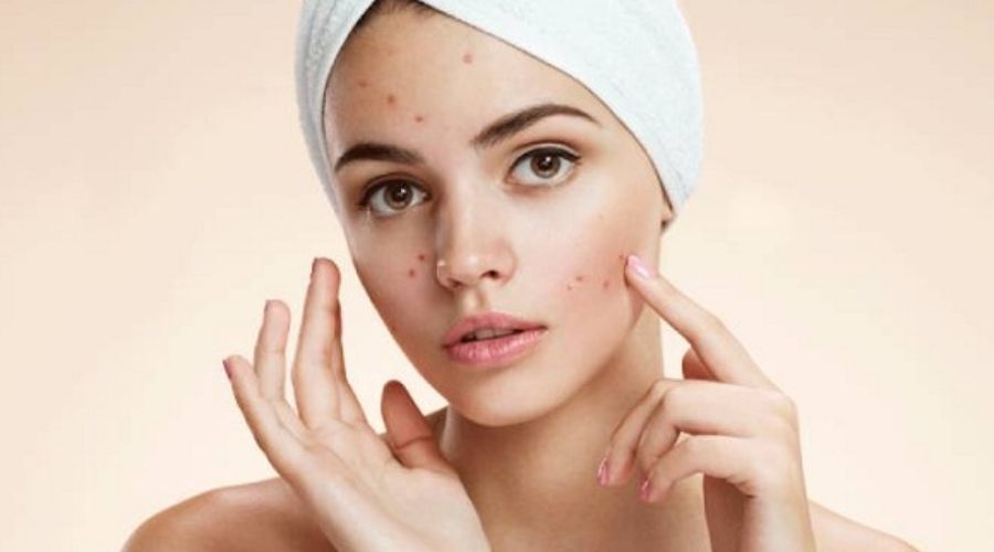 Kẽm Oxit Trong Mỹ Phẩm Trị Mụn